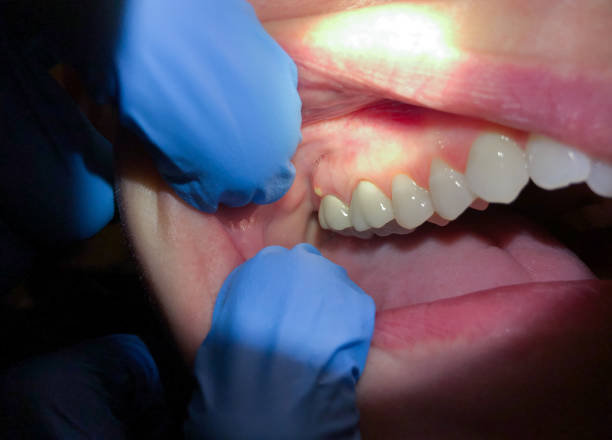 Best Emergency Dental Care for Broken or Chipped Teeth in Chesterfield, MO